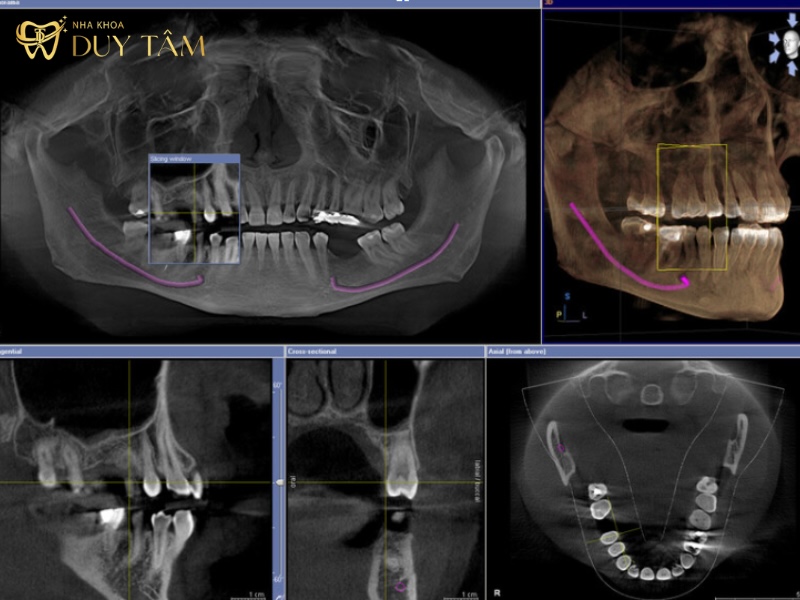 Trước khi cấy ghép Implant cần thăm khám tổng quát răng miệng, chụp X-quang, CT