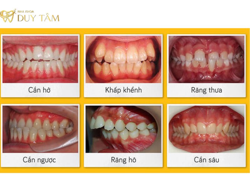 Nếu răng ở tình trạng xấu, chi phí niềng răng sẽ cao hơn