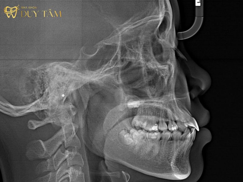 Hình ảnh X-Quang giúp nha sĩ có cái nhìn toàn diện về cấu trúc răng và xương hàm