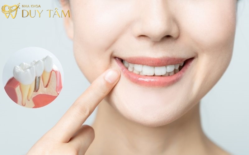 Có nên trồng răng Implant không?