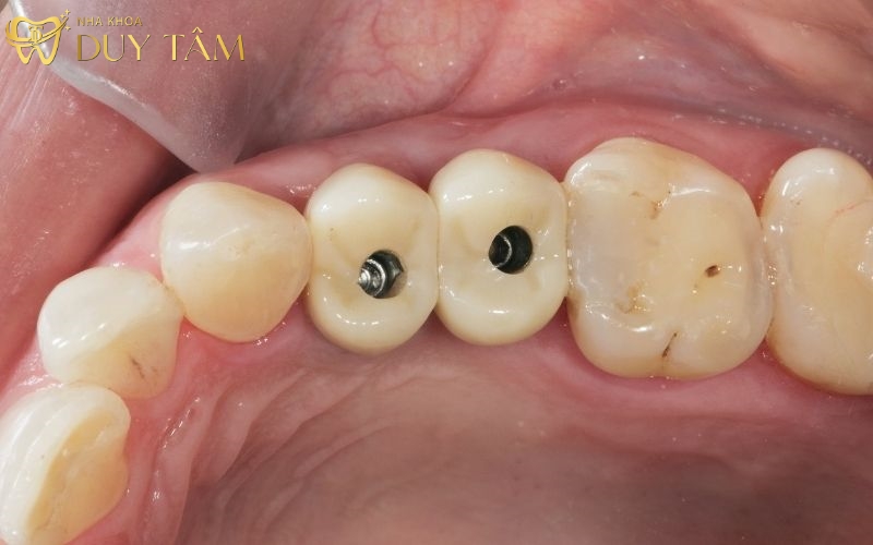 Trồng răng Implant giúp bảo vệ tối đa sức khỏe của răng tự nhiên