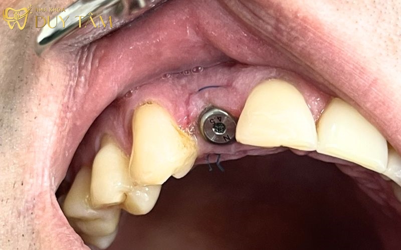 Khi nào thì nên trồng răng Implant?