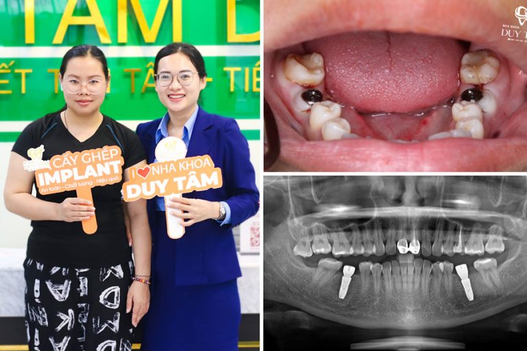 Thuc Hien Trong 2 Tru Implant