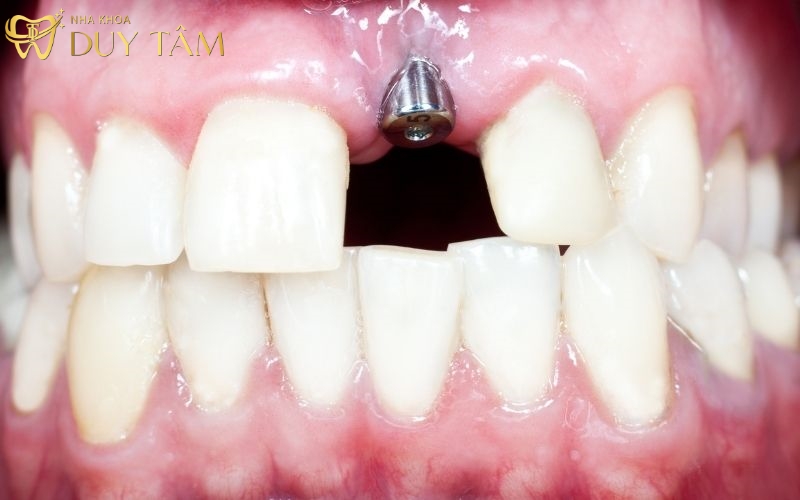 trồng răng Implant mất bao lâu?