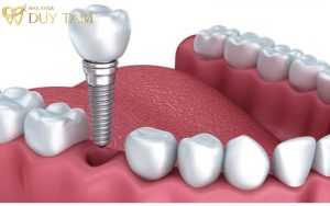 Thời gian trồng răng Implant mất bao lâu?