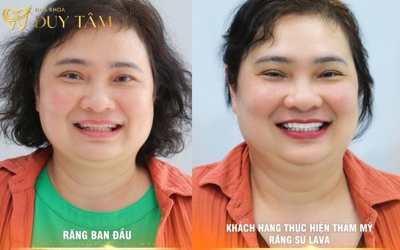 Thành quả của chị Minh Anh sau khi trồng răng Implant 