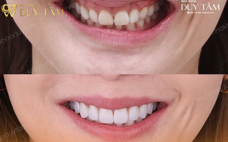 Kết quả sau trồng răng Implant của chị Tuyết An tại Nha Khoa Duy Tâm