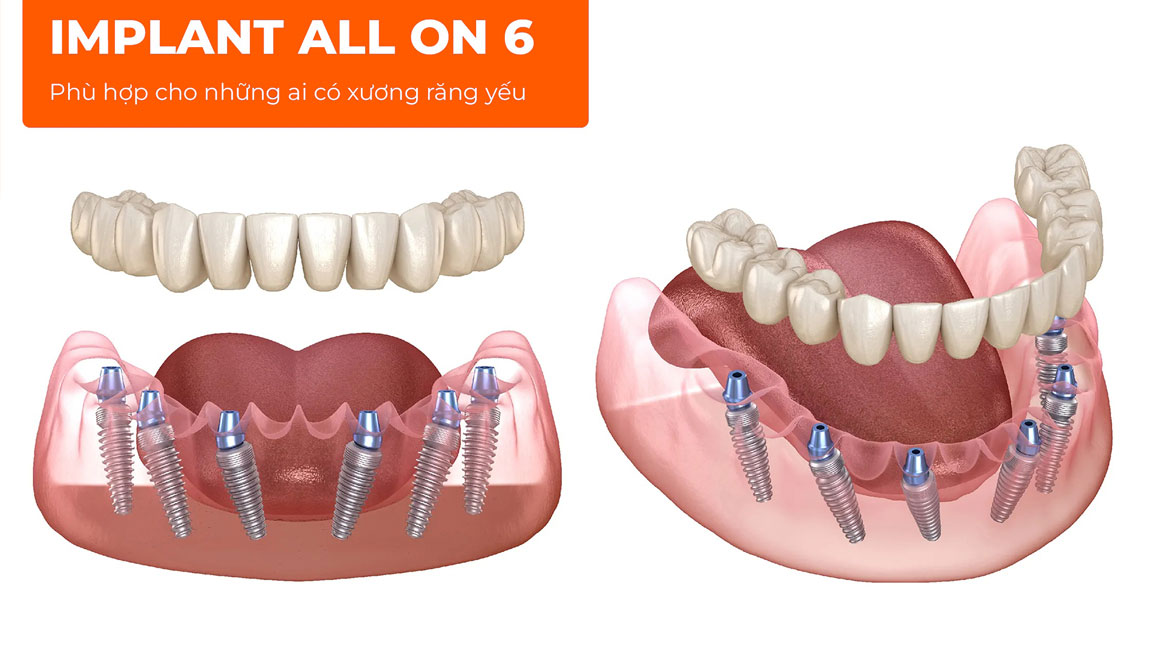 Trong Rang Implant Toan Ham