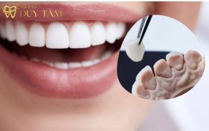 Quy trình dán Veneer chuẩn y khoa với 5 bước đảm bảo mang lại hàm răng thẩm mỹ cao