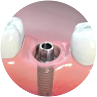 Quy Trinh Implant 2