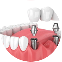 Quy Trinh Implant 4