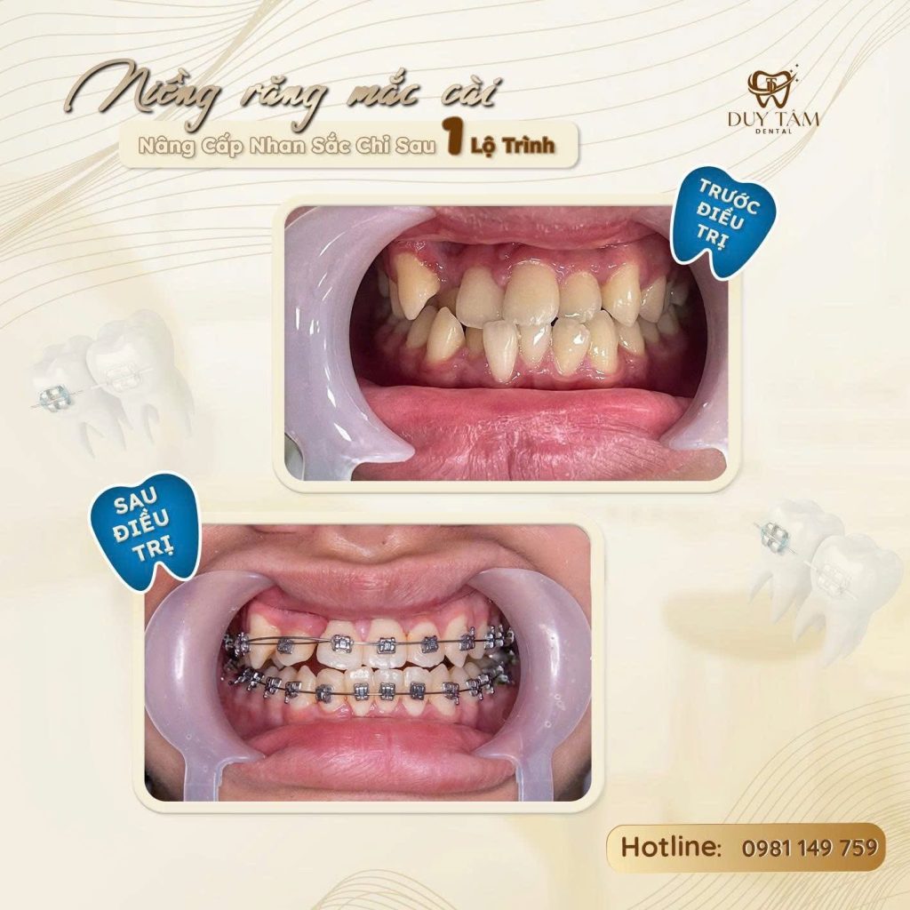 Kinh Nghiệm Khi Niềng Răng Mắc Cài