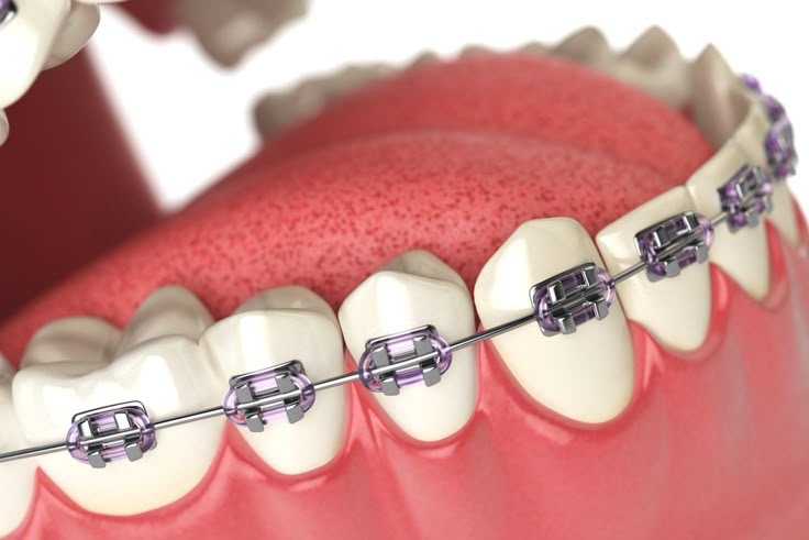 Niềng răng mắc cài là gì?