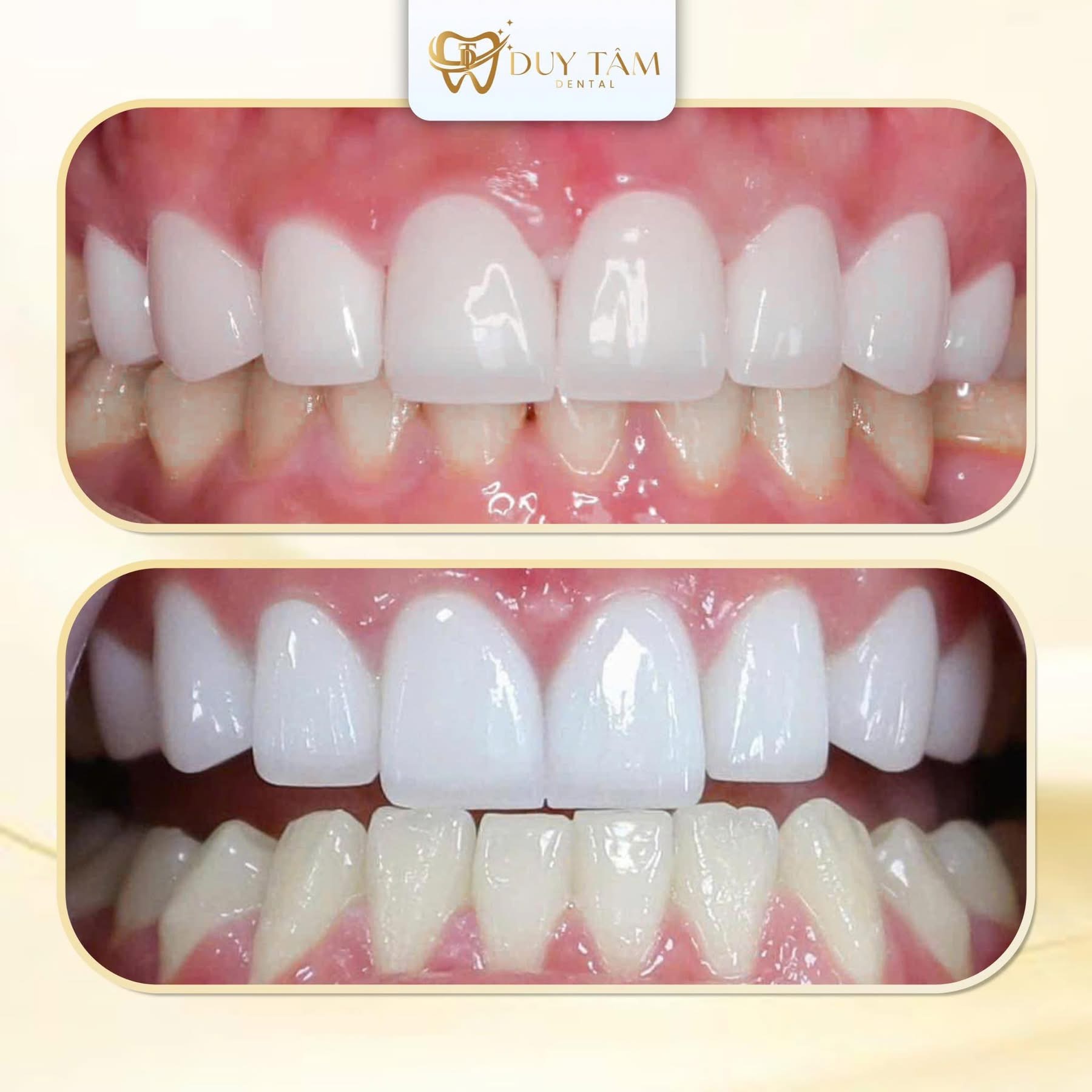 Tẩy trắng răng có bị ê buốt không?