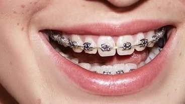 Niềng răng mắc cài