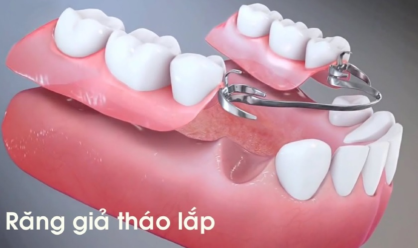 Tháo lắp hàm giả
