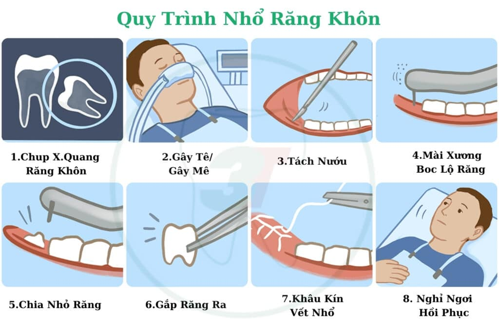 quy trình nhổ răng khôn