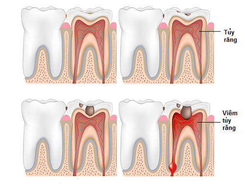 Điều Trị Tủy Răng