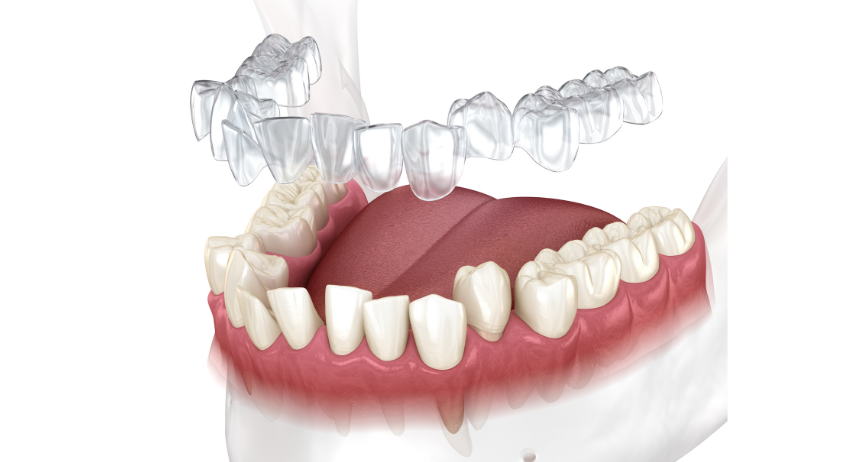 Ưu điểm của niềng răng trong suốt